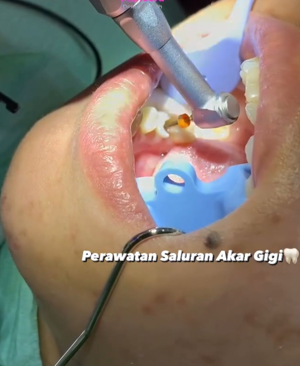 Perawatan Saluran Akar